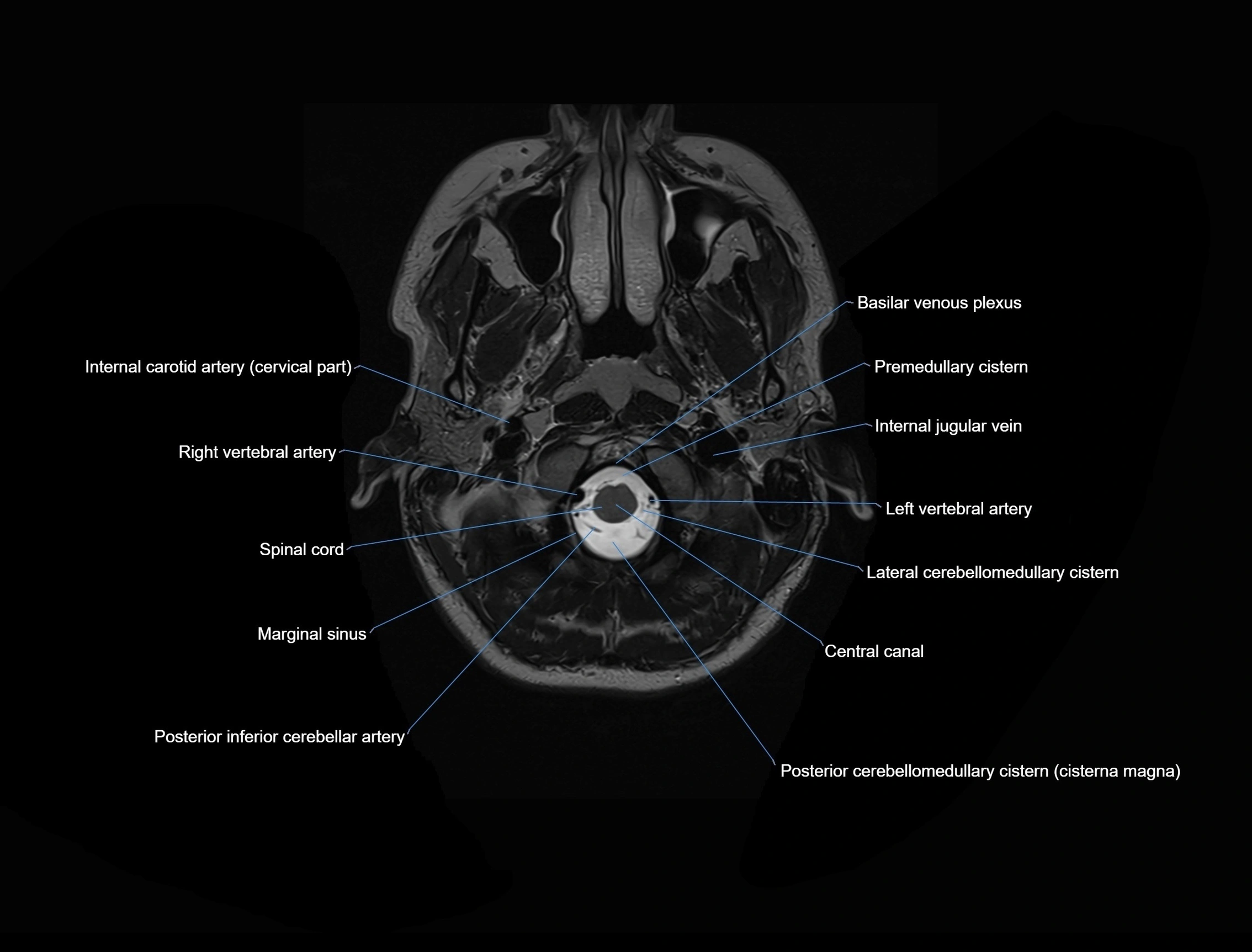 MRI Brain axial cross sectional radiology anatomy 3T image  -img-00001-00002.webp